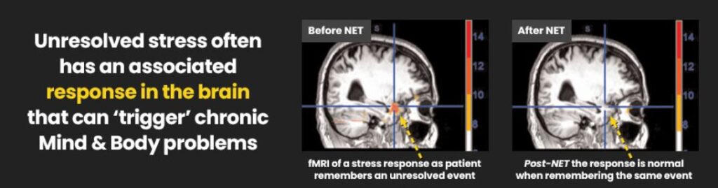 NET brain trauma research PSTD Treatments with Neuro-Emotional Therapy